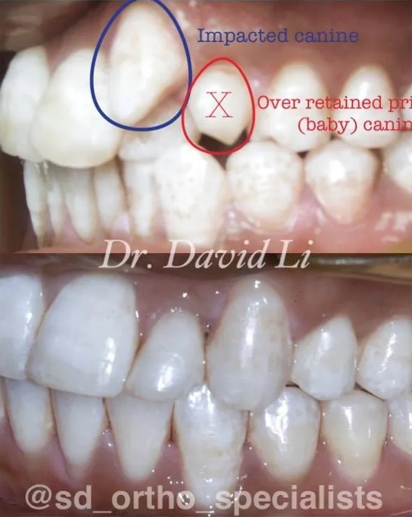 Impacted canine before and after