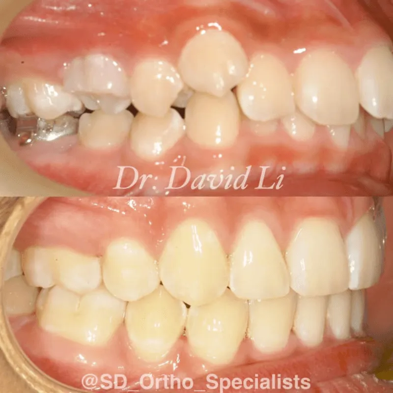 Extraction case for best results