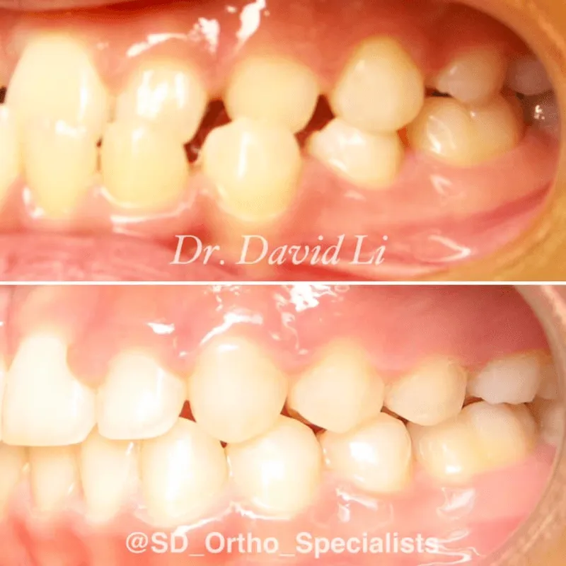 Severe underbite correction