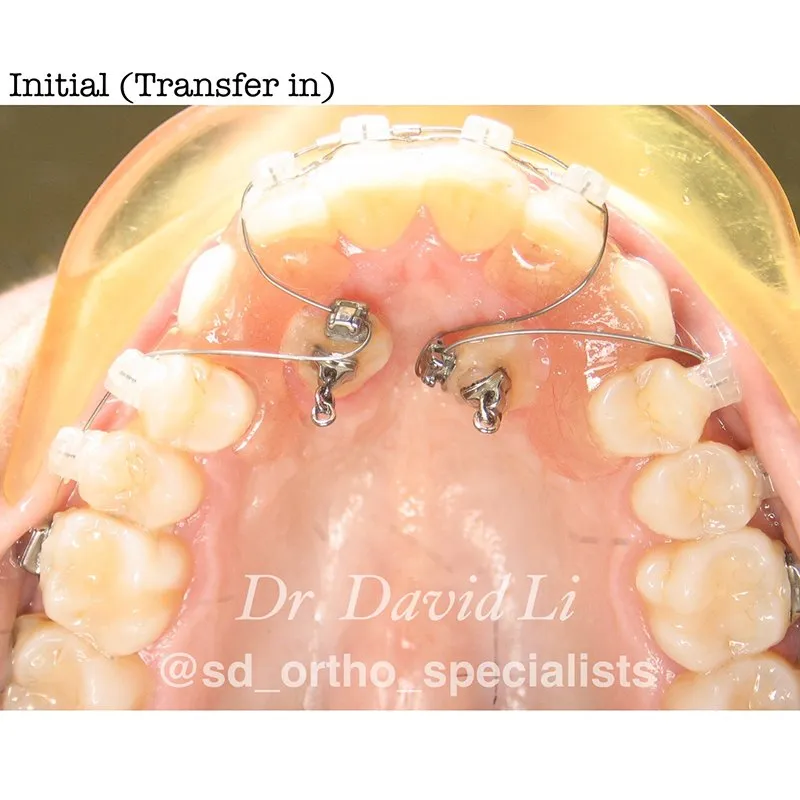 Impacted canines before treatment