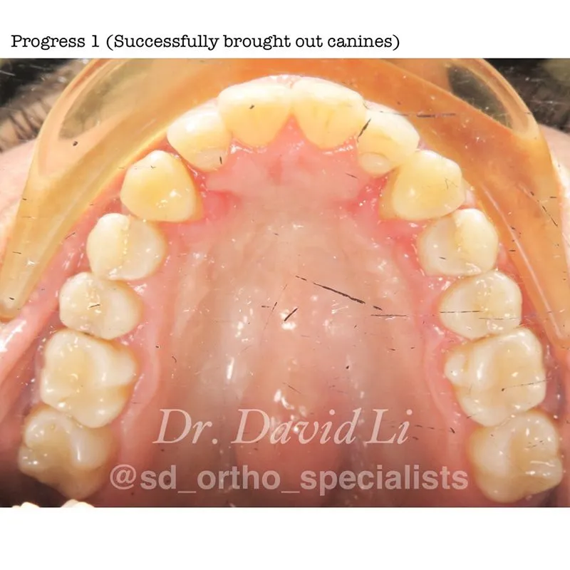 Impacted canines during treatment