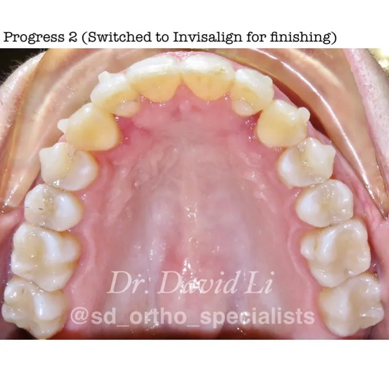 Impacted canines progress