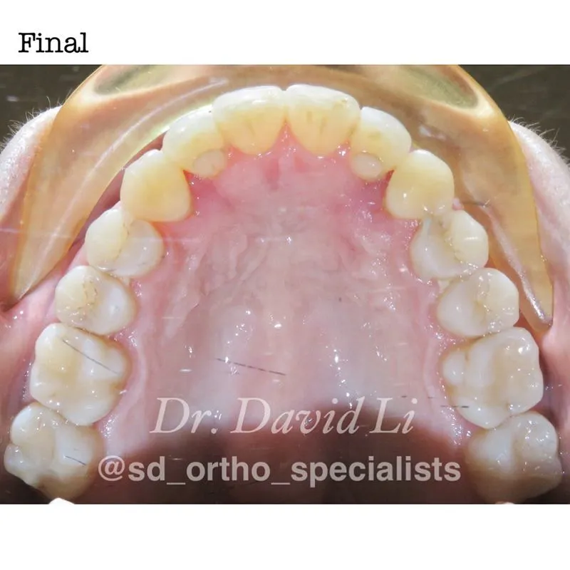 Impacted canines final result