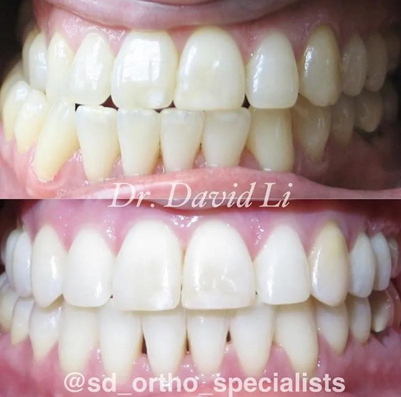 Jaw surgery transformation