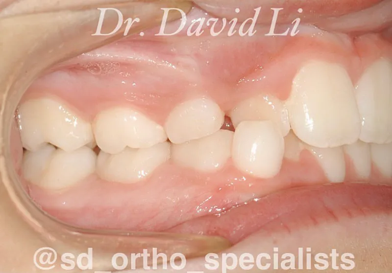 Phase I treatment before