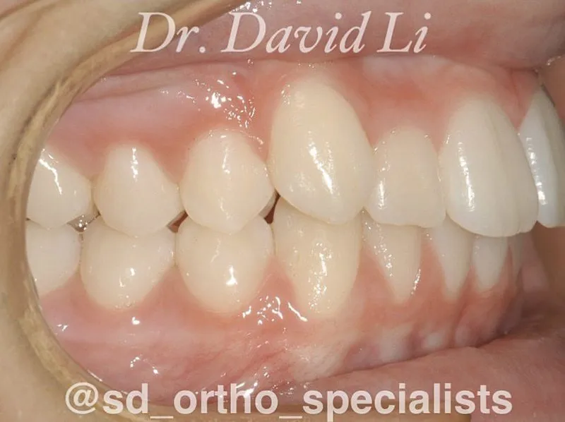 Phase I treatment after