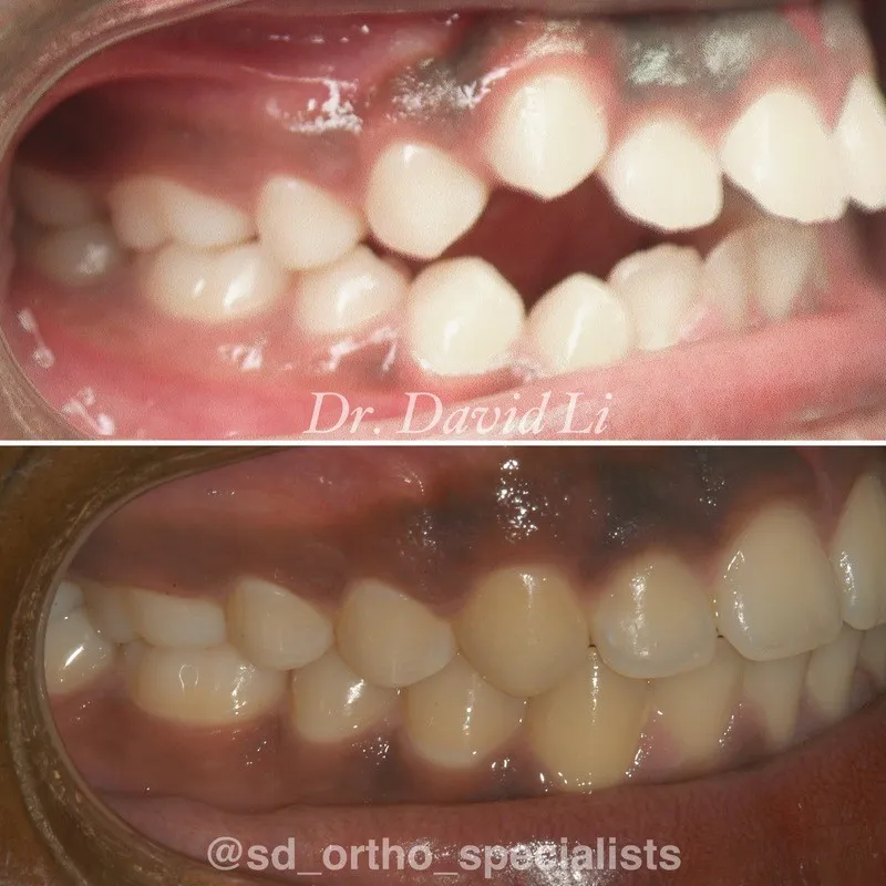 Amazing orthodontic transformation