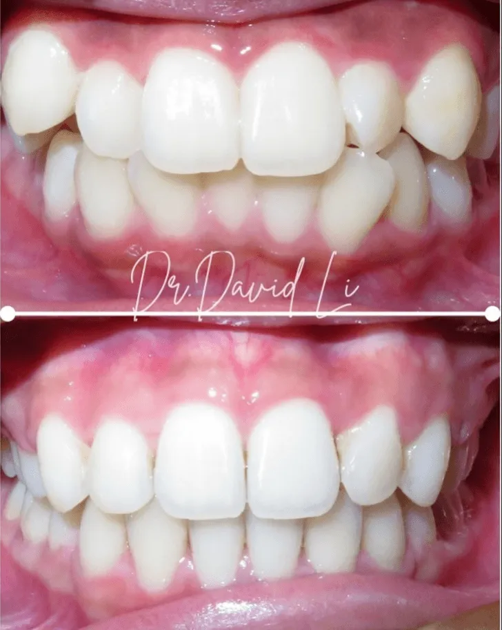 Crowding correction before and after