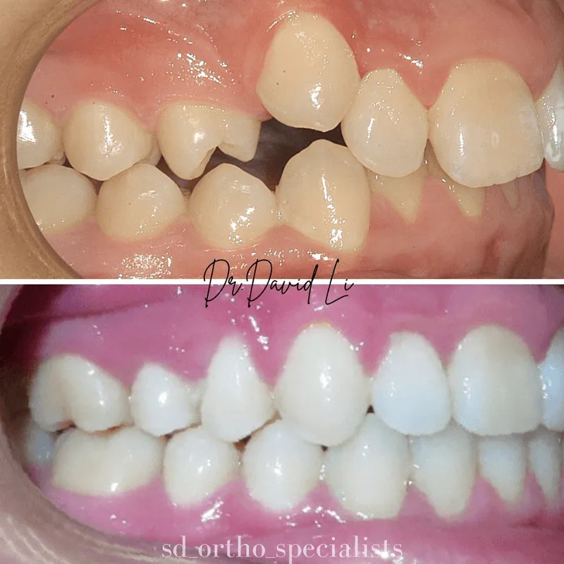 Damon System snaggle tooth correction