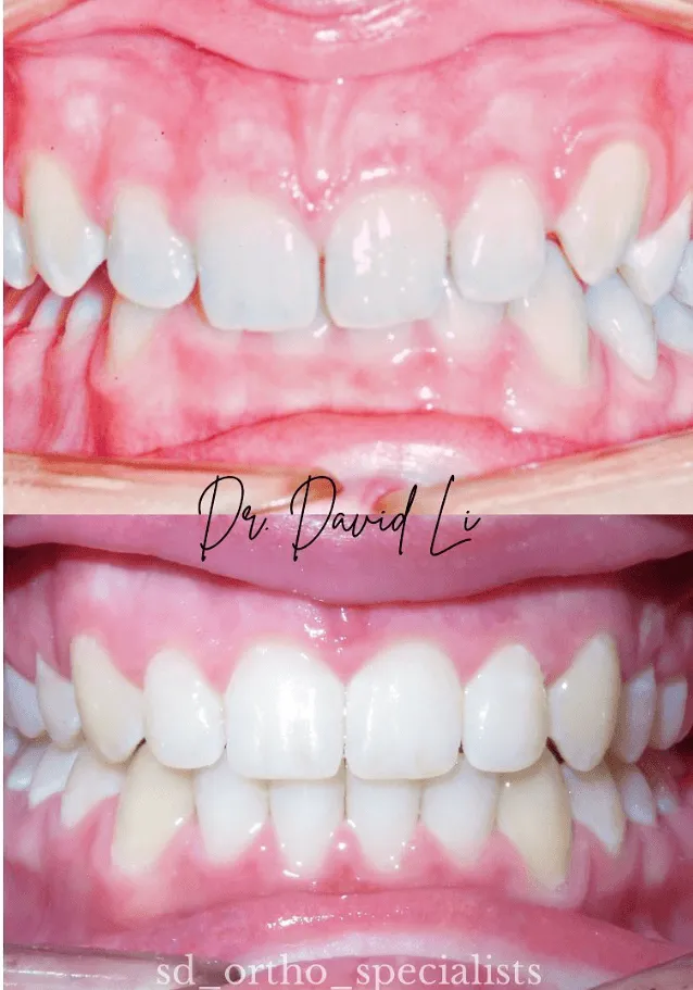Deep overbite Invisalign correction
