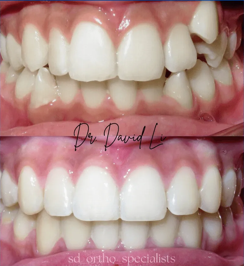 Crowding and deep bite with braces