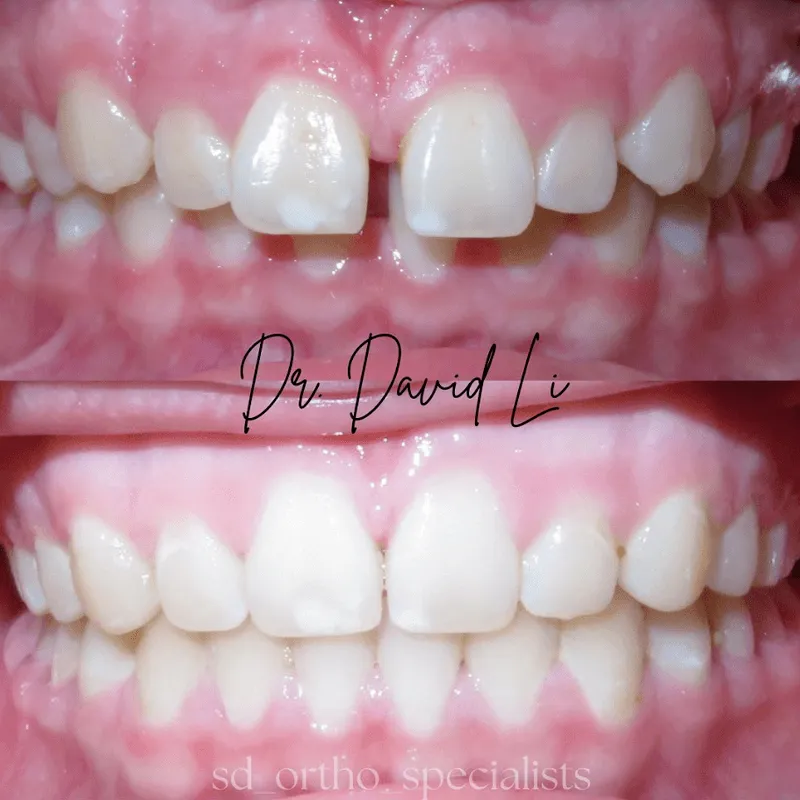 Diastema gap closure