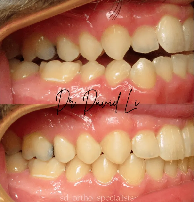 Crossbite open bite and crowding correction