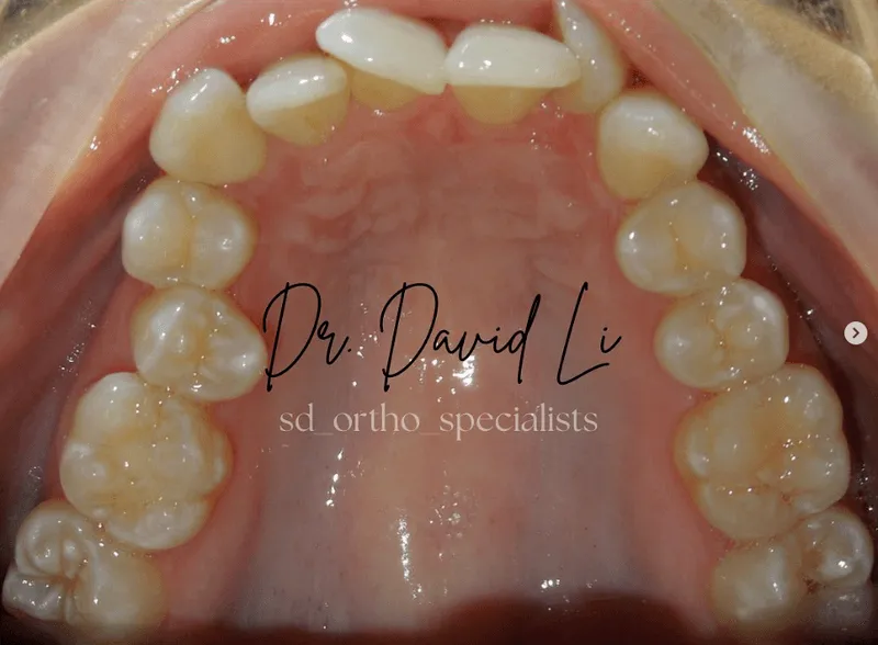 Crowding correction with braces or Invisalign