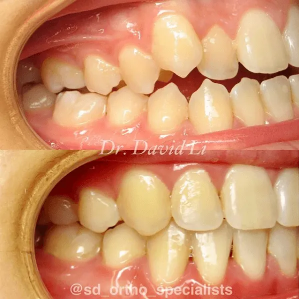 Cross-bite, open-bite and crowding correction
