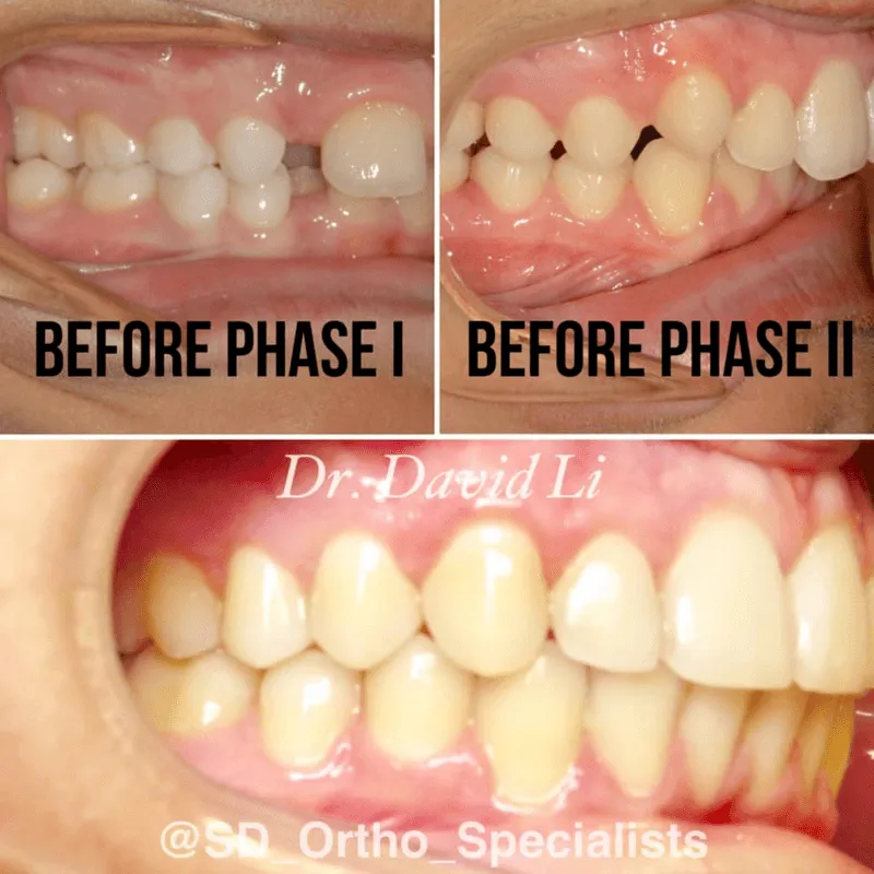 Two-phase treatment results