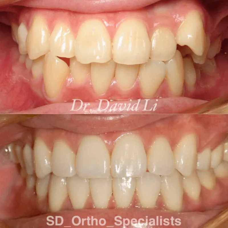 Dental crowding correction
